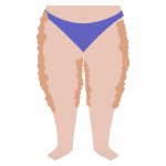 aydin-lipodem-tedavisi-kusadasi-fizyoterapist