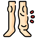 lenfodem-tedavisi-aydin-fizyoterapist-kusadasi-fizyoterapi